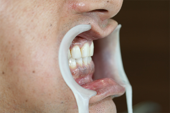 オールセラミッククラウン（e-max）,オールセラミッククラウン（e-max）の症例写真 今よりもっと白く大きな歯に,Before,ba_ceramic09_b.jpg