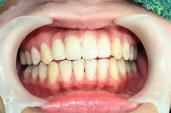 オールセラミッククラウン（e-max）,歯のエステ,オールセラミッククラウン（e-max）の症例写真 上顎前歯の出っ歯の修正,After,ba_ceramic13_a01.jpg