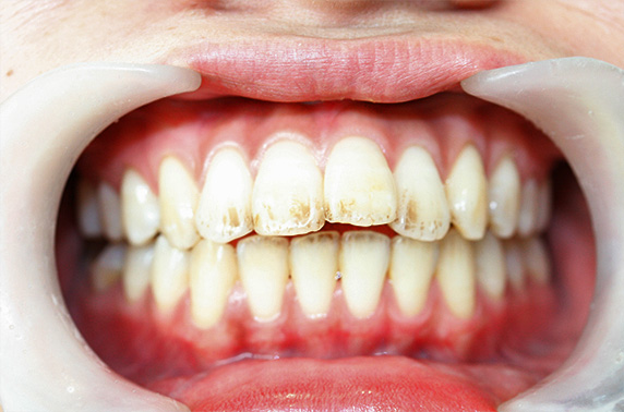 オールセラミッククラウン（e-max）,オールセラミッククラウン（e-max）の症例写真 上顎前歯の出っ歯の修正,Before,ba_ceramic13_b.jpg