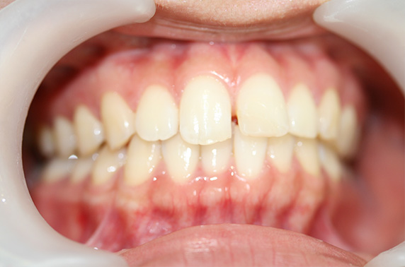 症例写真,オールセラミッククラウン（e-max）の症例写真 上顎前歯のすき間と出っ張り,Before,ba_ceramic15_b.jpg