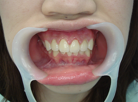 オールセラミッククラウン（e-max）,オールセラミッククラウン（e-max）の症例写真 上顎前歯が出ている,After,ba_ceramic17_b.jpg