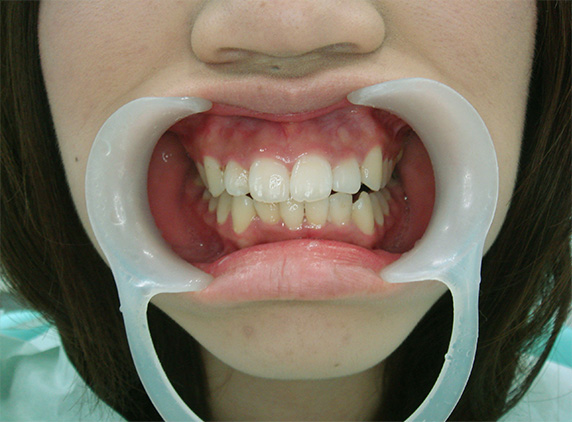 症例写真,オールセラミッククラウン（e-max）の症例写真 上顎前歯が出ている,Before,ba_ceramic17_b.jpg