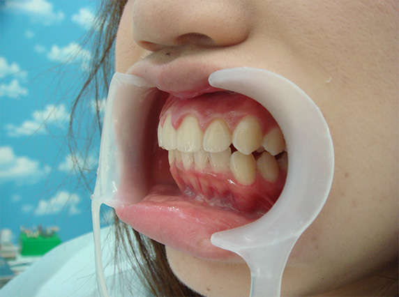 症例写真,オールセラミッククラウン（e-max）の症例写真 上顎前歯が出ている,After,ba_ceramic18_b.jpg