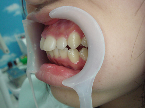 症例写真,オールセラミッククラウン（e-max）の症例写真 上顎前歯が出ている,Before,ba_ceramic18_b.jpg