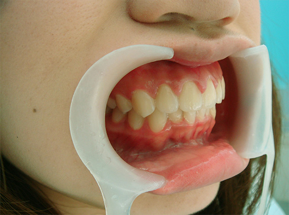 症例写真,オールセラミッククラウン（e-max）の症例写真 上顎前歯が出ている,After,ba_ceramic19_b.jpg