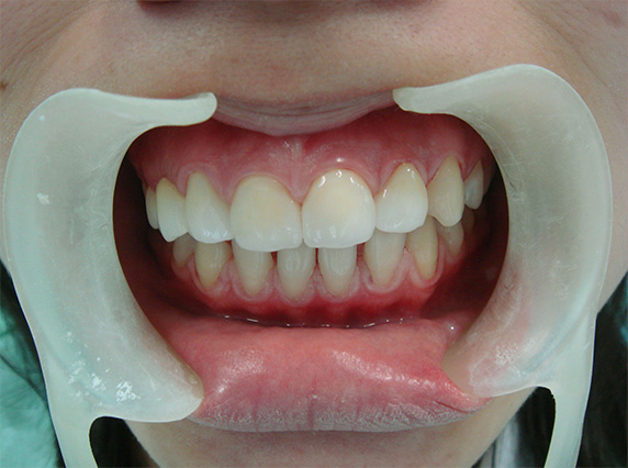 症例写真,オールセラミッククラウン（e-max）の症例写真 先天的欠損と矮小歯による隙間,After,ba_ceramic20_b.jpg