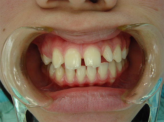 オールセラミッククラウン（e-max）の症例写真 先天的欠損と矮小歯による隙間,Before,ba_ceramic20_b.jpg
