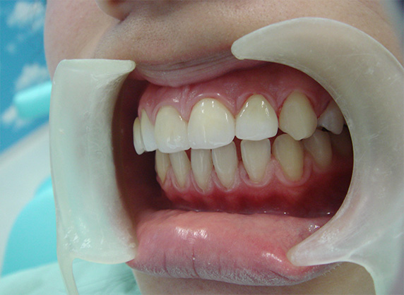 オールセラミッククラウン（e-max）,オールセラミッククラウン（e-max）の症例写真 先天的欠損と矮小歯による隙間,After,ba_ceramic21_b.jpg