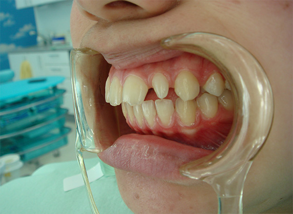 症例写真,オールセラミッククラウン（e-max）の症例写真 先天的欠損と矮小歯による隙間,Before,ba_ceramic21_b.jpg