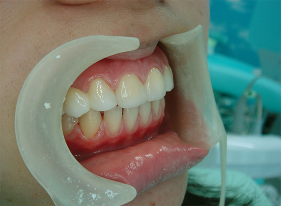 オールセラミッククラウン（e-max）,オールセラミッククラウン（e-max）の症例写真 先天的欠損と矮小歯による隙間,After,ba_ceramic22_b.jpg