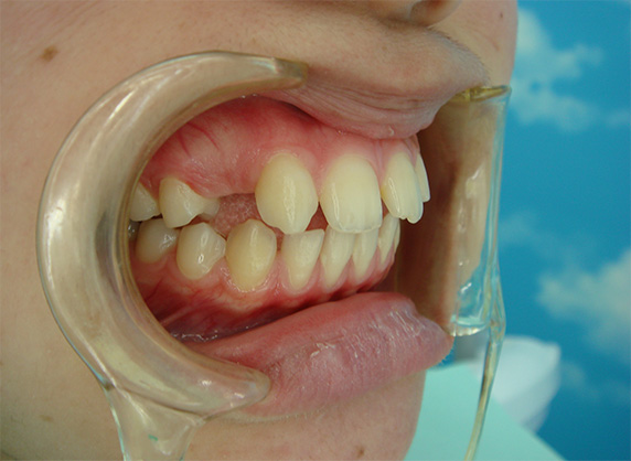 オールセラミッククラウン（e-max）,オールセラミッククラウン（e-max）の症例写真 先天的欠損と矮小歯による隙間,Before,ba_ceramic22_b.jpg