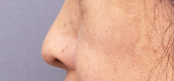 鼻中隔延長（鼻先を大きく下方に延ばす）,鼻中隔延長（鼻先を大きく下方に延ばす）の症例写真,After,ba_bichukaku02_b.jpg