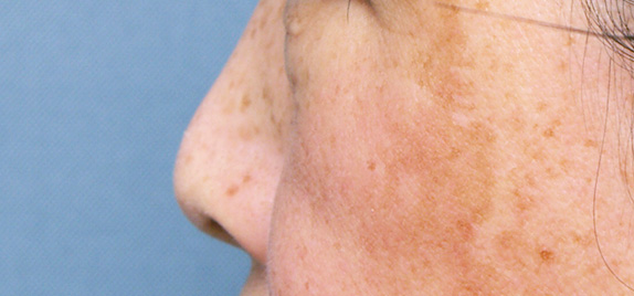 鼻中隔延長（鼻先を大きく下方に延ばす）,鼻中隔延長（鼻先を大きく下方に延ばす）の症例写真,Before,ba_bichukaku02_b.jpg