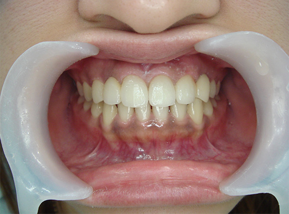 症例写真,オールセラミッククラウン（e-max）の症例写真 前歯部全体の隙間,After,ba_ceramic23_b.jpg