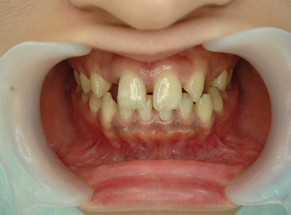 症例写真,オールセラミッククラウン（e-max）の症例写真 前歯部全体の隙間,Before,ba_ceramic23_b.jpg