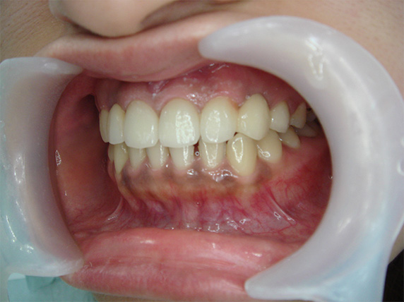症例写真,オールセラミッククラウン（e-max）の症例写真 前歯部全体の隙間,After,ba_ceramic24_b.jpg