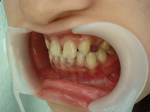 症例写真,オールセラミッククラウン（e-max）の症例写真 前歯部全体の隙間,Before,ba_ceramic24_b.jpg