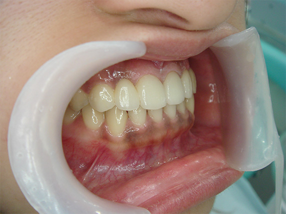 症例写真,オールセラミッククラウン（e-max）の症例写真 前歯部全体の隙間,After,ba_ceramic25_b.jpg