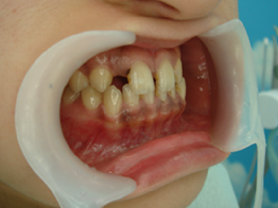 症例写真,オールセラミッククラウン（e-max）の症例写真 前歯部全体の隙間,Before,ba_ceramic25_b.jpg