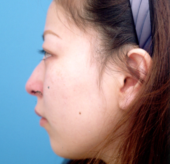 わし鼻・段鼻修正,ハンプ切除,あご形成（シリコンプロテーゼ）の症例 わし鼻・段鼻修正,ハンプ切除,Before,ba_hump05_b.jpg
