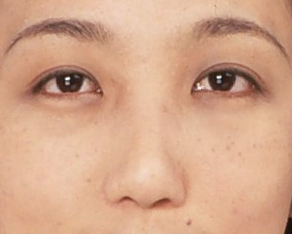 骨切幅寄せ（鼻の根元を細く）,わし鼻・段鼻修正,ハンプ切除,わし鼻・段鼻修正、ハンプ切除 鼻の根元が広がり目立っていた30代女性の症例,After,ba_hump12_a01.jpg