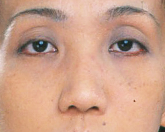わし鼻・段鼻修正,ハンプ切除,わし鼻・段鼻修正、ハンプ切除 鼻の根元が広がり目立っていた30代女性の症例,Before,ba_hump12_b.jpg