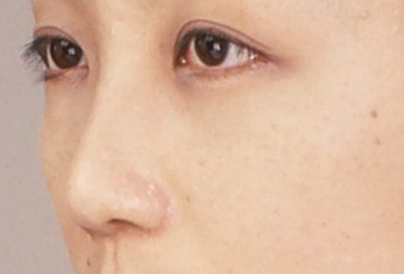 骨切幅寄せ（鼻の根元を細く）,わし鼻・段鼻修正、ハンプ切除 鼻の根元が広がり目立っていた30代女性の症例,After,ba_hump13_b.jpg