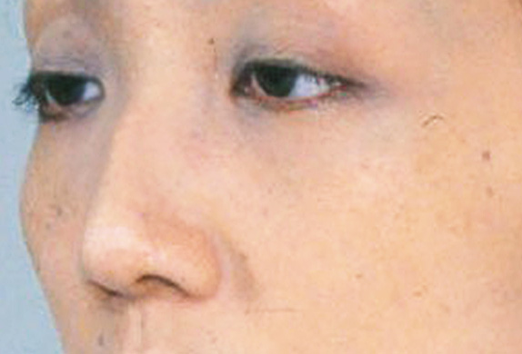 骨切幅寄せ（鼻の根元を細く）,わし鼻・段鼻修正、ハンプ切除 鼻の根元が広がり目立っていた30代女性の症例,Before,ba_hump13_b.jpg