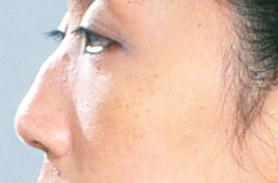 骨切幅寄せ（鼻の根元を細く）,わし鼻・段鼻修正、ハンプ切除 鼻の根元が広がり目立っていた30代女性の症例,Before,ba_hump14_b.jpg