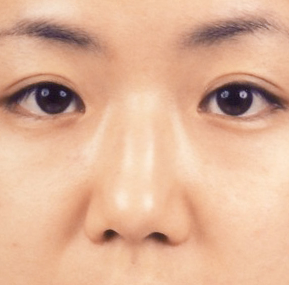 骨切幅寄せ（鼻の根元を細く）,わし鼻・段鼻修正、ハンプ切除 骨切幅寄せとワシ鼻を修正した30代女性の症例,Before,ba_hump09_b.jpg