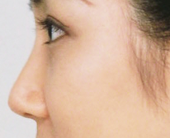症例写真,わし鼻・段鼻修正、ハンプ切除 骨切幅寄せとワシ鼻を修正した30代女性の症例,After,ba_hump11_b.jpg