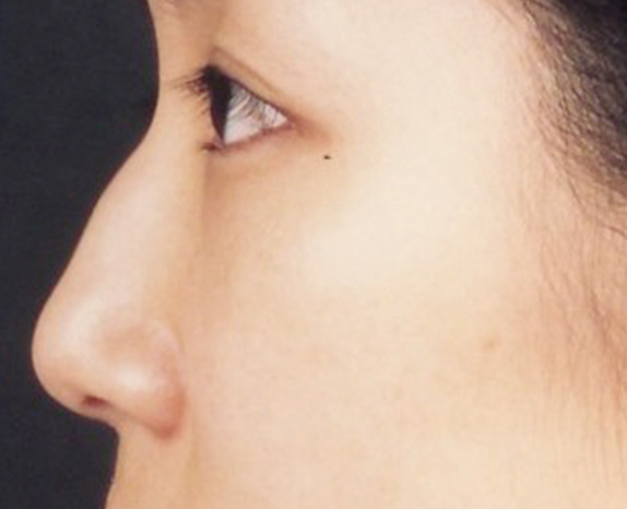 骨切幅寄せ（鼻の根元を細く）,わし鼻・段鼻修正、ハンプ切除 骨切幅寄せとワシ鼻を修正した30代女性の症例,Before,ba_hump11_b.jpg