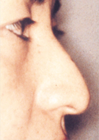 わし鼻・段鼻修正,ハンプ切除,わし鼻・段鼻修正、ハンプ切除 高さ大きさがあり段もついていた女性の症例,Before,ba_hump06_b.jpg