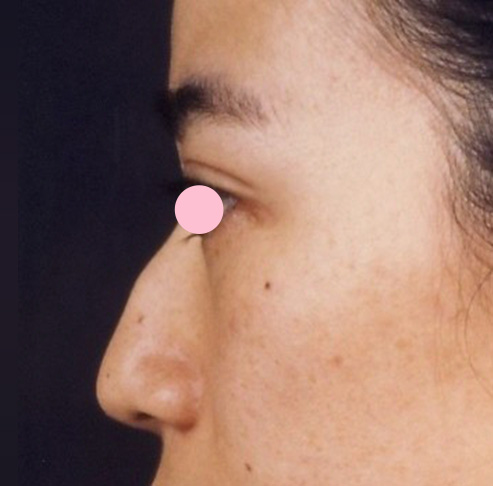 症例写真,わし鼻・段鼻修正、ハンプ切除の症例写真 軽いワシ鼻の女性,Before,ba_hump04_b.jpg