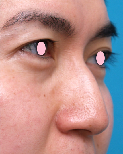 わし鼻・段鼻修正,ハンプ切除,軽度のワシ鼻にヒアルロン酸注射で修正した症例写真,Before,ba_hump15_b.jpg