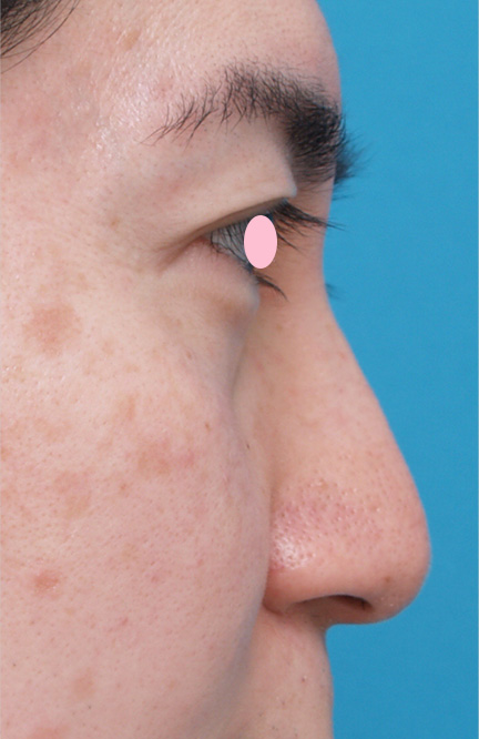 わし鼻・段鼻修正,ハンプ切除,軽度のワシ鼻にヒアルロン酸注射で修正した症例写真,After,ba_hump16_b.jpg
