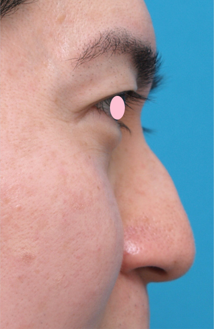 隆鼻注射（ヒアルロン酸注射）,軽度のワシ鼻にヒアルロン酸注射で修正した症例写真,Before,ba_hump16_b.jpg