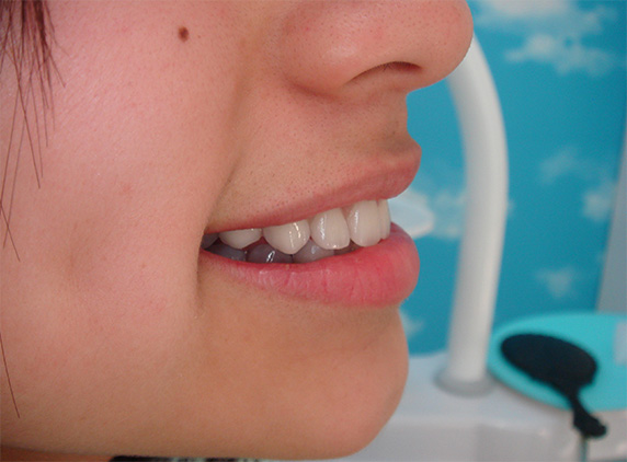 オールセラミッククラウン（e-max）の症例写真 テトラサイクリン歯,After,ba_ceramic29_a01.jpg