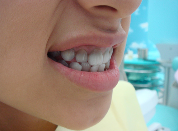 オールセラミッククラウン（e-max）の症例写真 テトラサイクリン歯,Before,ba_ceramic29_b.jpg