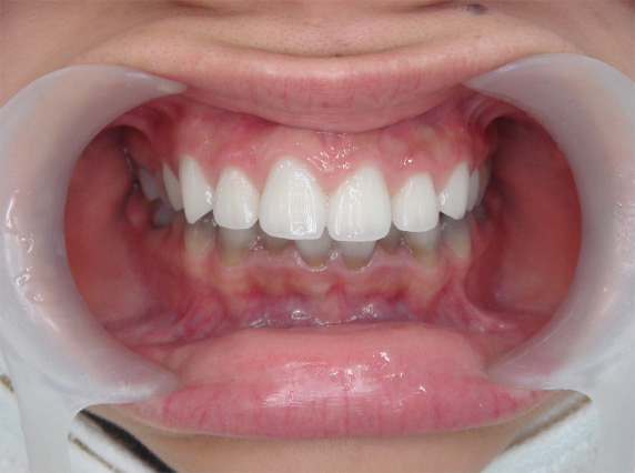 症例写真,オールセラミッククラウン（e-max）の症例写真 テトラサイクリン歯,After,ba_ceramic30_b.jpg