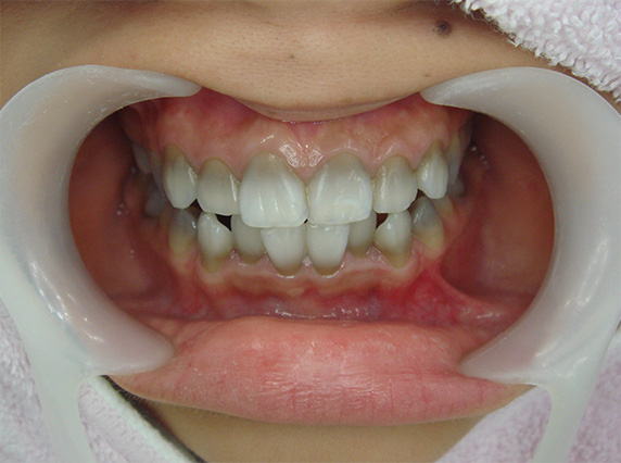 オールセラミッククラウン（e-max）,オールセラミッククラウン（e-max）の症例写真 テトラサイクリン歯,Before,ba_ceramic30_b.jpg