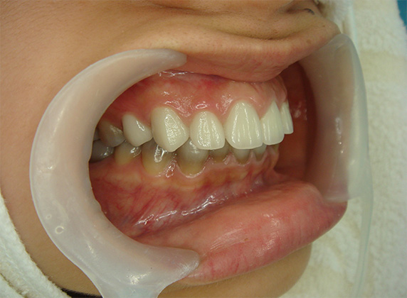 症例写真,オールセラミッククラウン（e-max）の症例写真 テトラサイクリン歯,After,ba_ceramic31_b.jpg