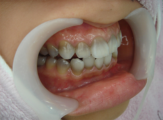 オールセラミッククラウン（e-max）,オールセラミッククラウン（e-max）の症例写真 テトラサイクリン歯,Before,ba_ceramic31_b.jpg