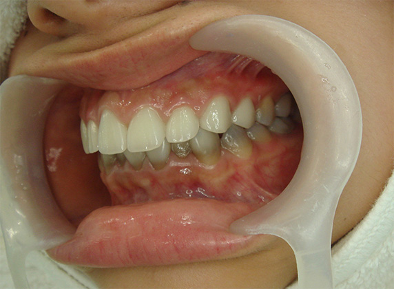 症例写真,オールセラミッククラウン（e-max）の症例写真 テトラサイクリン歯,After,ba_ceramic32_b.jpg