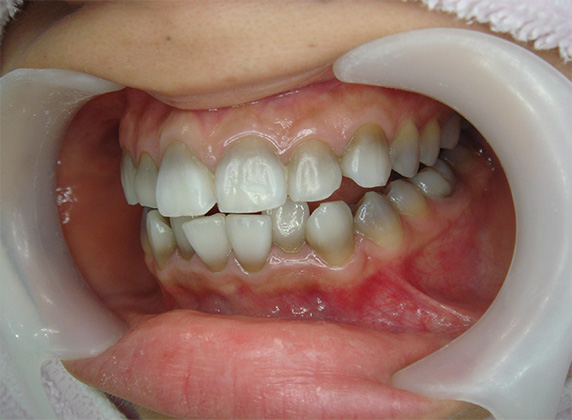 オールセラミッククラウン（e-max）,オールセラミッククラウン（e-max）の症例写真 テトラサイクリン歯,Before,ba_ceramic32_b.jpg