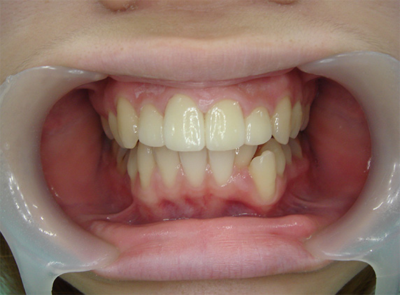 オールセラミッククラウン（e-max）,オールセラミッククラウン（e-max）の症例写真 上顎の前歯2本を引っ込めたい,After,ba_ceramic39_a01.jpg