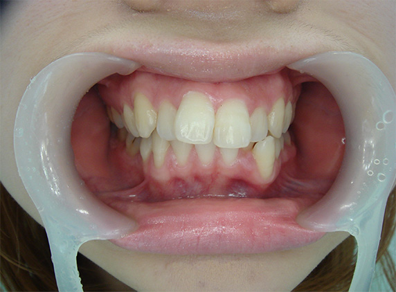 オールセラミッククラウン（e-max）,オールセラミッククラウン（e-max）の症例写真 上顎の前歯2本を引っ込めたい,Before,ba_ceramic39_b.jpg