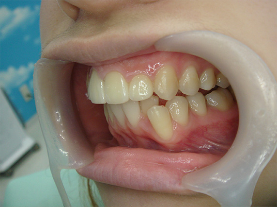 オールセラミッククラウン（e-max）,オールセラミッククラウン（e-max）の症例写真 上顎の前歯2本を引っ込めたい,After,ba_ceramic40_b.jpg