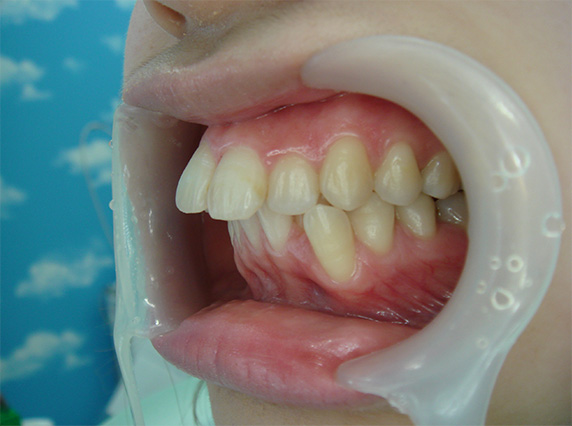 症例写真,オールセラミッククラウン（e-max）の症例写真 上顎の前歯2本を引っ込めたい,Before,ba_ceramic40_b.jpg