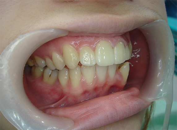 症例写真,オールセラミッククラウン（e-max）の症例写真 上顎の前歯2本を引っ込めたい,After,ba_ceramic41_b.jpg